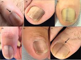 Image result for Acral lentiginous melanoma nail