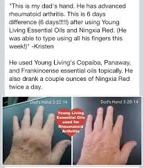 Wow Rheumatoid Arthritis Essential Oils Heal Naturally Www Youngliving Com Becomeamemb Arthritis Essential Oils Essential Oils Health Healing Essential Oils
