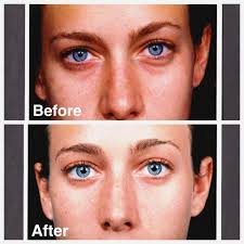 Why I Had A Lower Blepharoplasty Travel Beauty Eye Surgery Plastic Surgery Skin