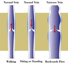 Blog Can Compression Stockings Help With Venous Reflux Disease