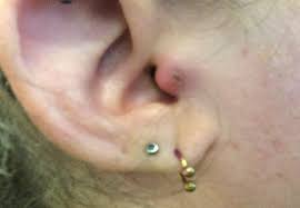 It may take up to 6 months or. Infected Tragus Piercing Key Symptoms Treatments Lady Piercing
