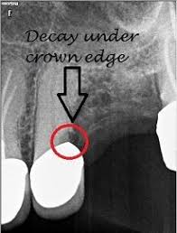How to tell if you need a root canal on a crowned tooth. Do You Need A Dental Crown After Root Canal Bauer Smiles