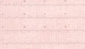 Image result for Hyperkalemia Management
