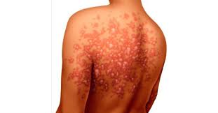 Todo lo que hay que saber. Culebrilla La Enfermedad Que Se Activa Con El Estres Y Podria Causar Ceguera