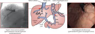Portal hypertension refers to abnormally high pressure in the hepatic portal vein. Emerging Non Invasive Approaches For Diagnosis And Monitoring Of Portal Hypertension The Lancet Gastroenterology Hepatology