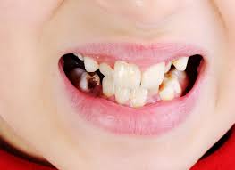 Image result for Tooth Extraction