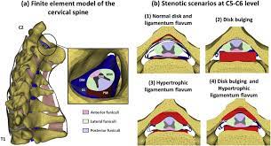 Проверьте 'ligamentum flavum' перевод на английский. Numerical Investigation Of The Relative Effect Of Disc Bulging And Ligamentum Flavum Hypertrophy On The Mechanism Of Central Cord Syndrome Sciencedirect