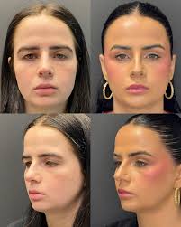 Only 6 weeks out ✨ This 27-year-old patient had an upper blepharoplasty  (eyelid reduction) with Dr. Singh—done under local anesthesia while awake!  Many patients choose this quick procedure for its minimal discomfort