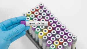 Namun, kasus telah diamati di mana tanda. Bagaimana Cara Pemeriksaan Penyakit Hepatitis B