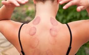 What both kinesiotape and cupping have in common, other than a lack of evidence that they work, is. Olympic Athletes Benefit From Cupping Therapy Geoff Brown Lic Ac