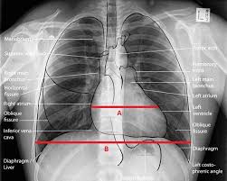 Basics Of Reading Chest Xray Complete Guide To Cxr Beginners Medicforyou In 2020 Medical Radiography Radiology Student Radiology Imaging