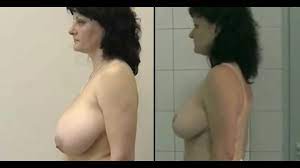 Breast reduction porn