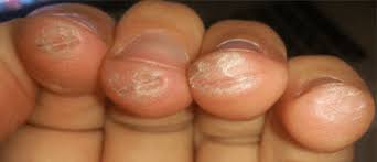 Here's what might be causing it. How To Build Guitar Calluses Take Care Of Your Fingers Ledgernote