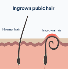 Ingrown hair is hair that has curled and grown back into the skin instead of growing outwards. What Is An Ingrown Pubic Hair Roman Healthguide