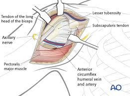 In the shoulder it's commonly more than just one structure that gets affected. Deltopectoral Approach To The Proximal Humerus