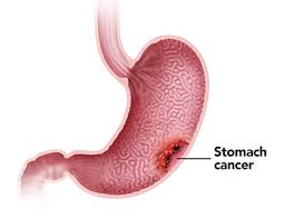Acest tip de cancer de stomac se numește adenocarcinom al stomacului. Cancer Of Gastric Cancer Stomacal