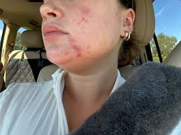 Hi. I recently bought the Kiehl's retinol and started using it two days  ago. I've noticed a couple of small breakouts since I started using it. Is  it normal to break out