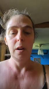 Fuzzy Ears After Lymph Drainage