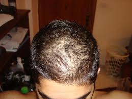 Typically at least the head is involved. Rapid Hair Shedding Diffuse Hair Thinning Will I Need A Ht Hair Restoration Questions And Answers Hair Restoration Network Community For And By Hair Loss Patients