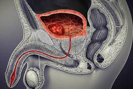 Even if you're vigilant about getting routine gyn care, bladder cancer may not really be on your radar. Bladder Cancer Symptoms Causes Diagnosis And Treatment
