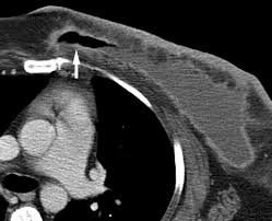 Learn more about it on our blog. Breast Lesions Incidentally Detected With Ct What The General Radiologist Needs To Know Radiographics