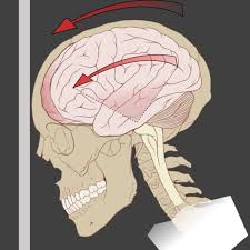 How to tell if a toddler has a concussion. Signs Of A Concussion In Children Wehavekids