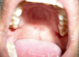Image result for granuloma gum disease