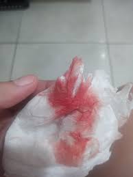 Pilula do dia seguinte | BabyCenter