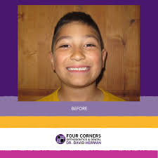 I love my new smile because it looks good for my sports pictures. Everyone  at Dr. Herman's office is nice and friendly!" -Abel Abel is from  Bloomfield, New Mexico and plays football