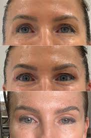 Exciting news! 📢 WE NEED MODELS! In preparation for our Plasma Fibroblast  Master Classes, Etherealskin (formerly Luxe by Lauren) is offering 50% off  Plasma Fibroblast in exchange for treatment being filmed for