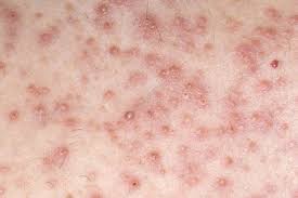 However, its effectiveness may differ depending on what suits you best. Ingrown Hairs Keyword Search Science Photo Library
