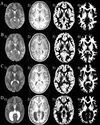 Looking for the definition of pvl? Gray Matter Volume Decrements In Preterm Children With Periventricular Leukomalacia Pediatric Research