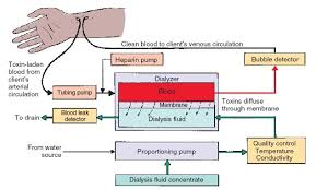Schematic Diagram Of Hemodialysis As The Patients Blood