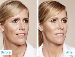 … continue reading the best ways to get rid of sagging jowls Elite Aesthetics On Twitter Get Rid Of Wrinkles Jowls Sagging Skin Rejuvenate And Restore Skin With Fillers Prp Plexr Threads Book Today Silhouettesoft Https T Co 2mgdwxqn15