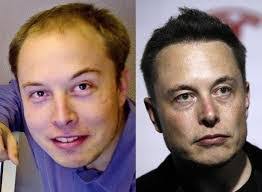 South african entrepreneur elon musk is known for founding tesla motors and spacex, which launched a landmark commercial spacecraft in 2012. Elon Musk Hair Transplant Before After