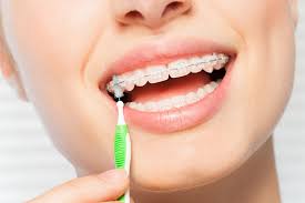 Preventing Cavities During Braces - Belmar Orthodontics