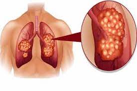 Si o sansa foarte buna de remisie, cu controlul simptomelor pe o durata foarte lunga. Cancerul Pulmonar Metastatic A Cum Apare Si Care Este Speranta De Viata Cancer La Plamani Metastaza