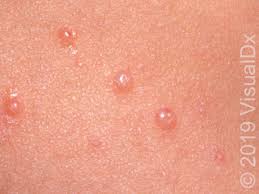Maybe you would like to learn more about one of these? Patient Education Molluscum Contagiosum Beyond The Basics Uptodate