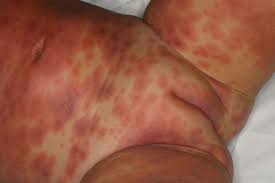 It can also sometimes be caused by an infection. A Review Of Causes Of Stevens Johnson Syndrome And Toxic Epidermal Necrolysis In Children Archives Of Disease In Childhood