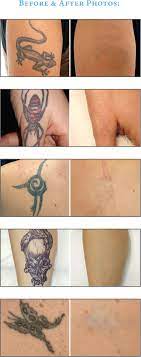 Tattoos used to be considered permanent, but thanks to advances in laser technology, today's lasers can get rid of tattoos more safely and effectively, including removing tattoo ink with fewer treatments and treating ink colors that were once difficult to remove. Tattoo Removal Los Angeles California Medical Spa