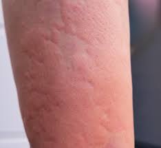 Image result for Hives