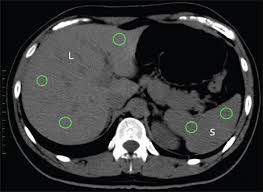 Unenhanced Ct Scan Meaning Ct Scan Machine