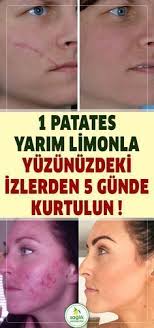 Yuzde Ne Kadar Iz Varsa Hepsinden 1 Patates Yarim Limonla Sadece 5 Gunde Kurt Gunde Hepsinden Iz Cilt Bakimi Dogal Guzellik Ipuclari Dogal Cilt Bakimi