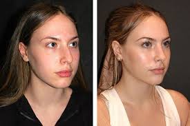 The nose may look red, swollen, and distorted. Rhinoplasty New York New York Nose Job Rhinoplasty Nyc