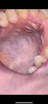 Image result for Mouth ulcers roof of mouth