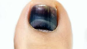 They grow at an average rate of 1.62 mm per month. Black Toenails From Running Or Walking