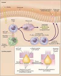 Celiac disease and dermatologic manifestations: Celiac Disease