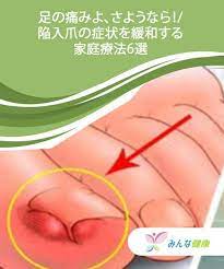 足の痛みよ さようなら 陥入爪の症状を緩和する家庭療法6選 陥入爪 足の痛み 痛み
