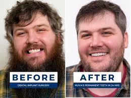 How Dental Implants Changed This Man's Future For Good