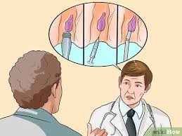 Quand l'intervention s'avère inéluctable, une technique novatrice, rafaelo, utilisant la radiofréquence permet de traiter les. 3 Manieres De Se Debarrasser Des Hemorroides Wikihow